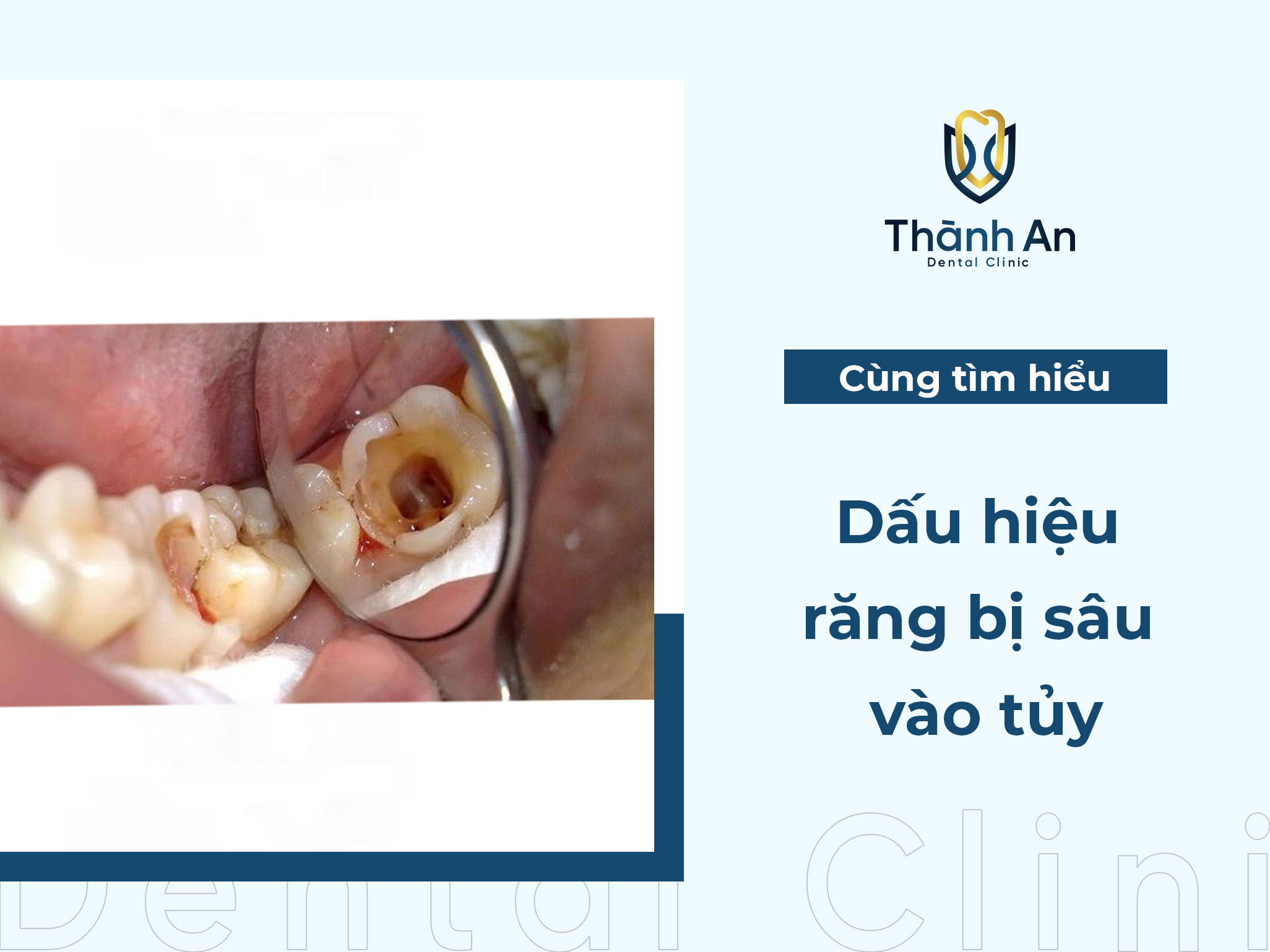 Nhận biết dấu hiệu răng bị sâu vào tủy và cách điều trị hiệu quả 