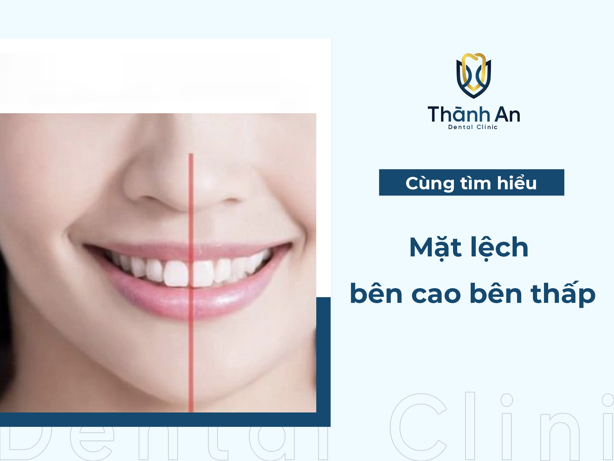 Mặt lệch bên cao bên thấp: Cách nhận biết và giải pháp khắc phục