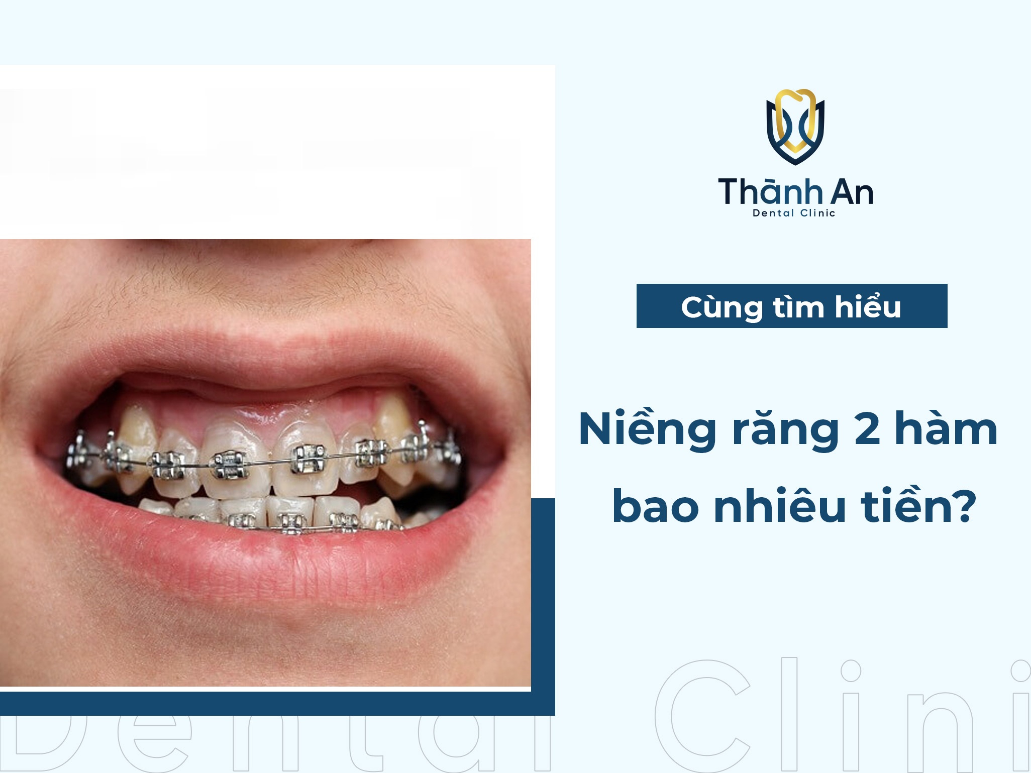 Giá niềng răng 2 hàm bao nhiêu? Bảng giá cập nhật mới nhất 2024