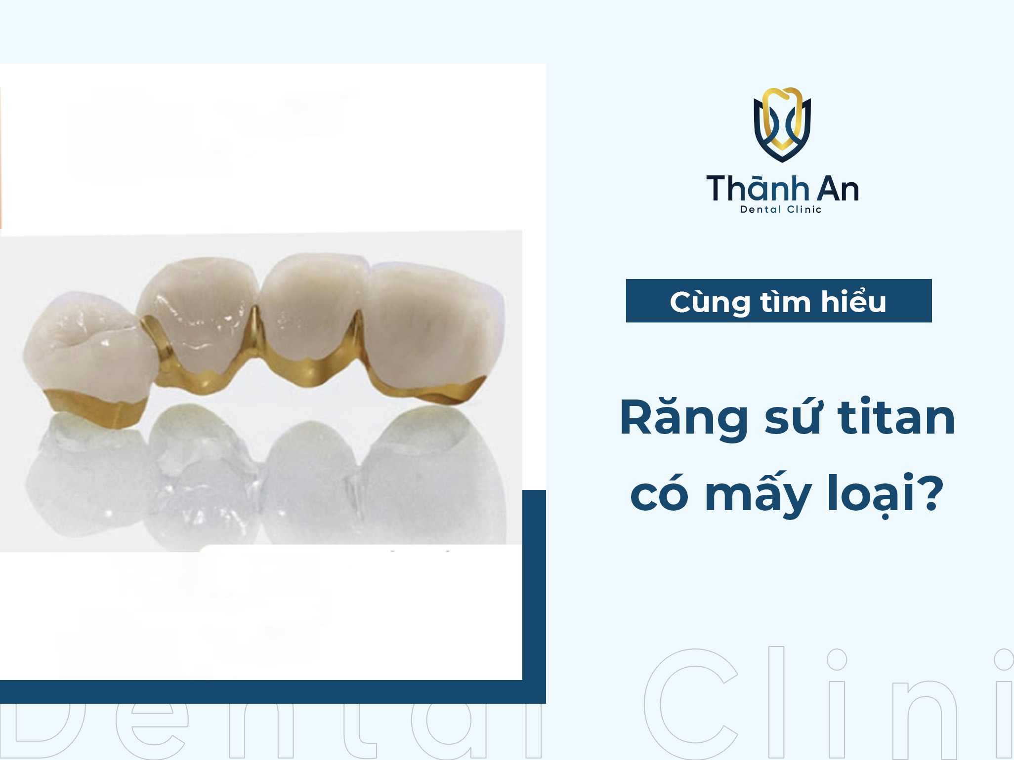 Răng sứ Titan có mấy loại? Đánh giá ưu - nhược điểm răng sứ Titan 