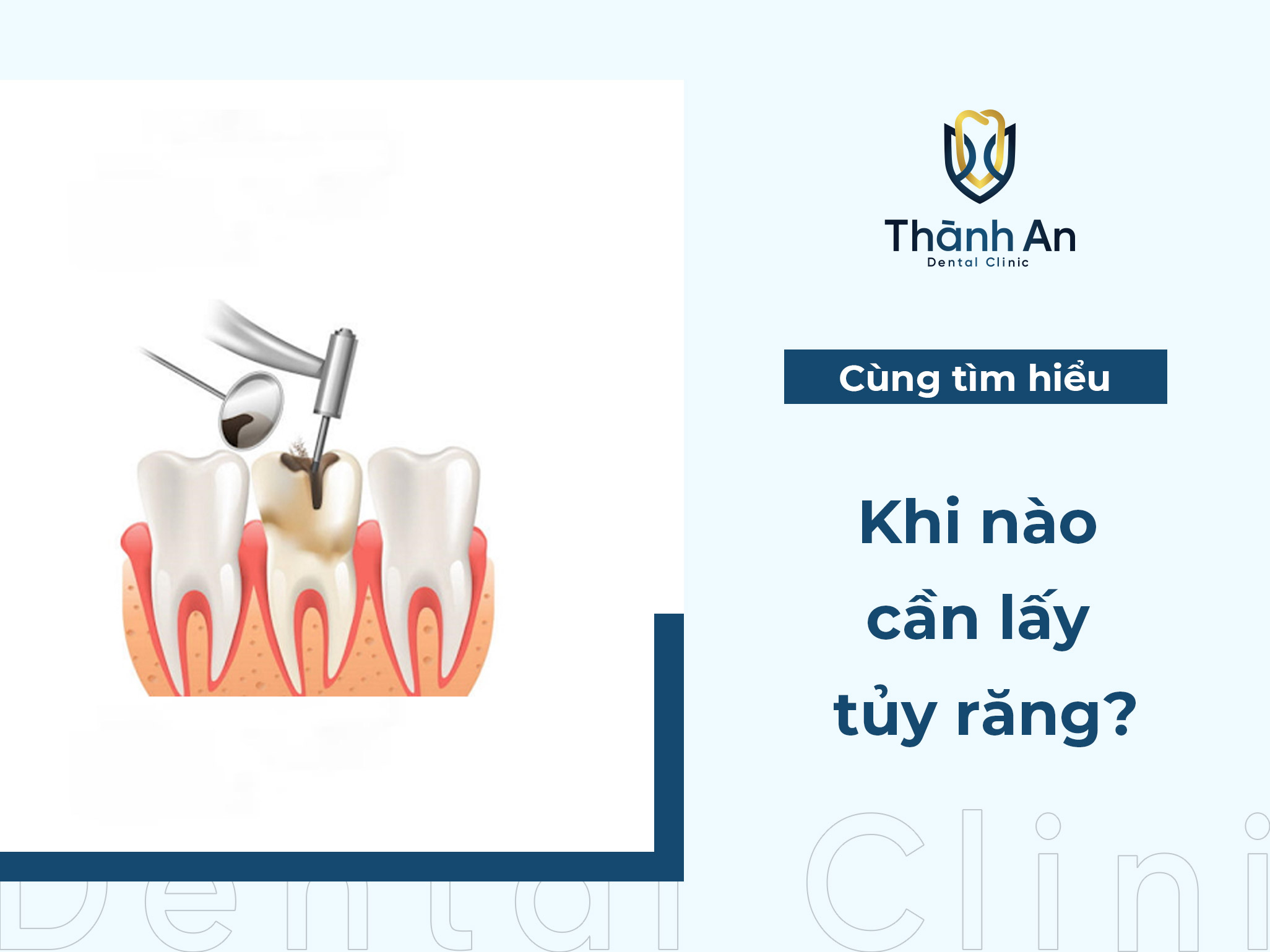 Khi nào cần lấy tủy răng? Lấy tủy răng mất bao lâu