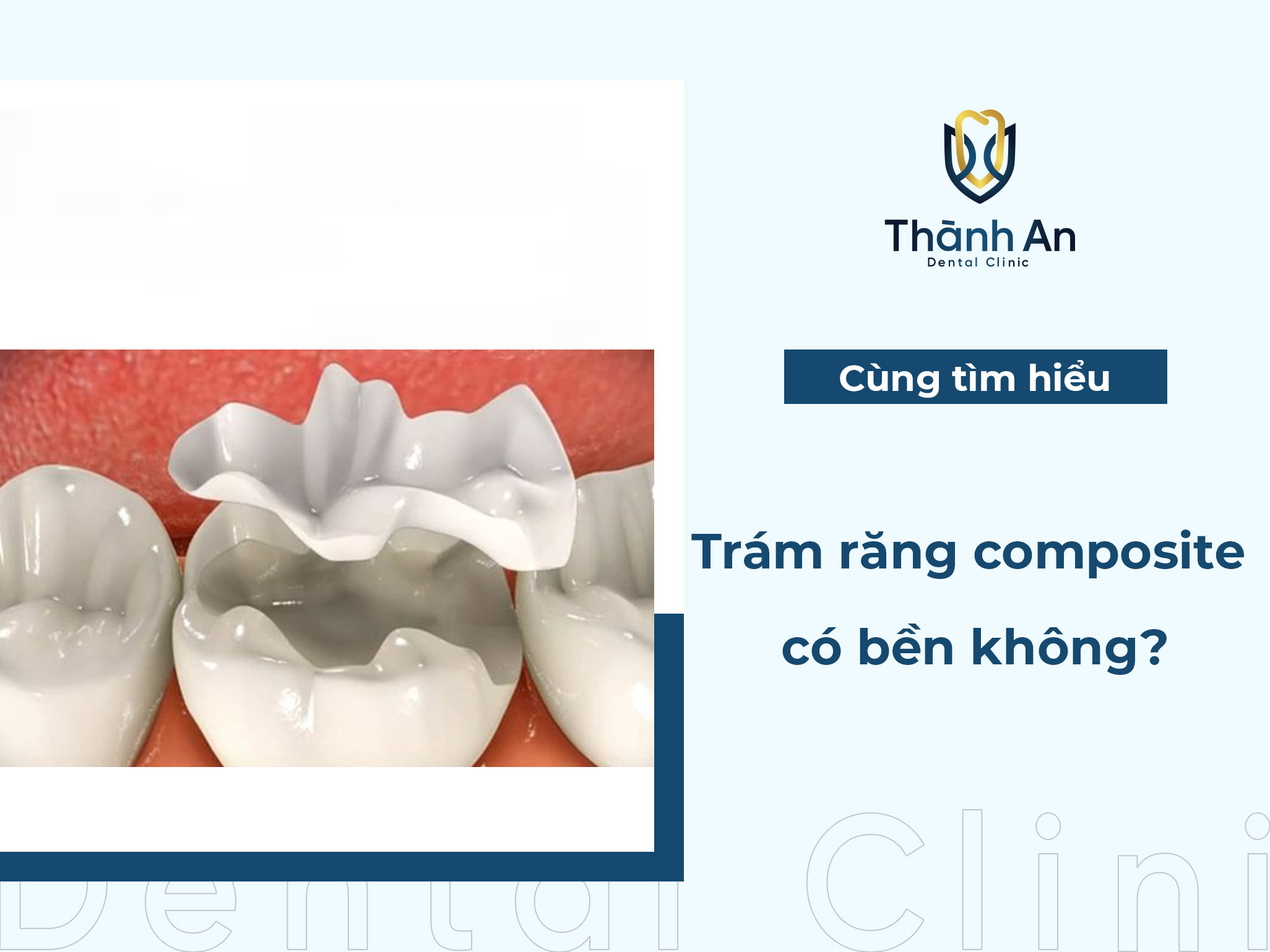 [Hỏi - Đáp] Trám răng composite có bền không?