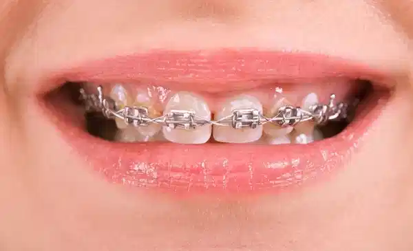 quá trình niềng răng hô nhổ răng