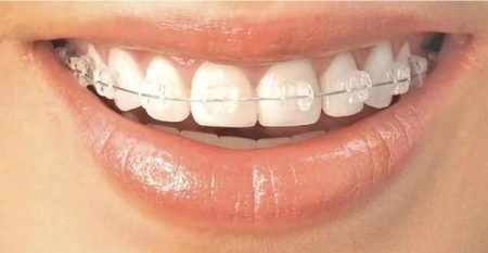 niềng răng hô hàm trên giá bao nhiêu