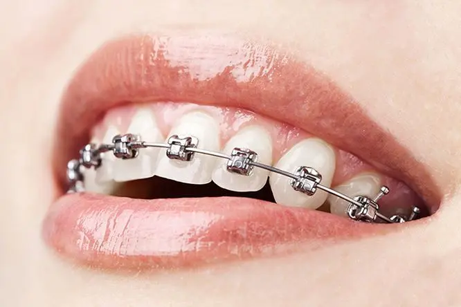 niềng răng hô hàm trên
