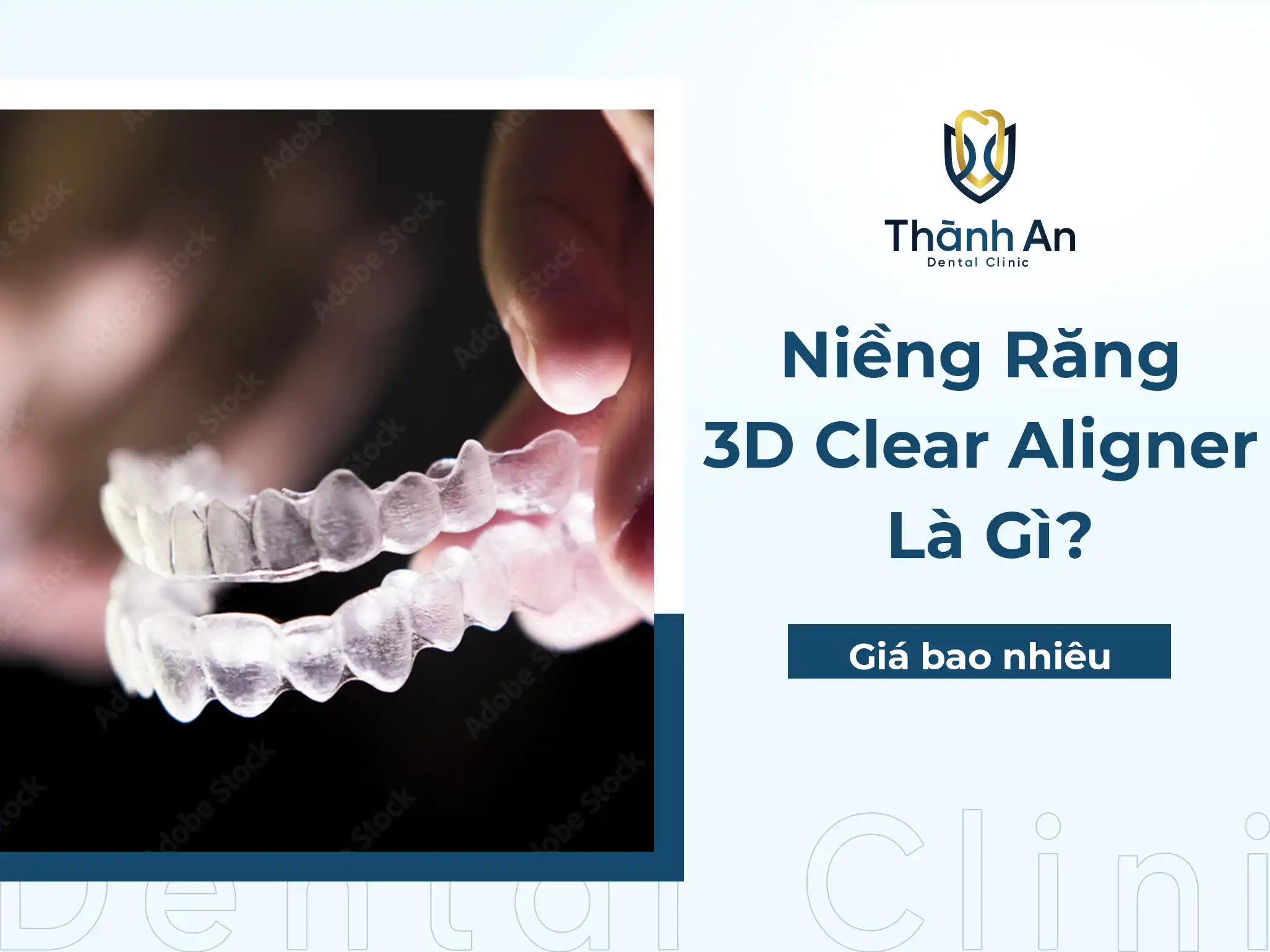 Niềng Răng 3D Clear Aligner Là Gì? Giá Bao Nhiêu Tiền?