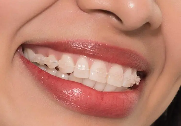 các loại niềng răng