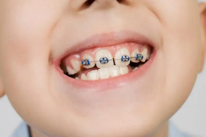 niềng răng cho trẻ em có đau không