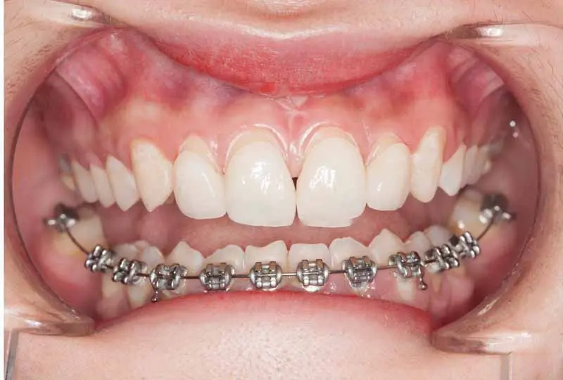 niềng răng hàm dưới
