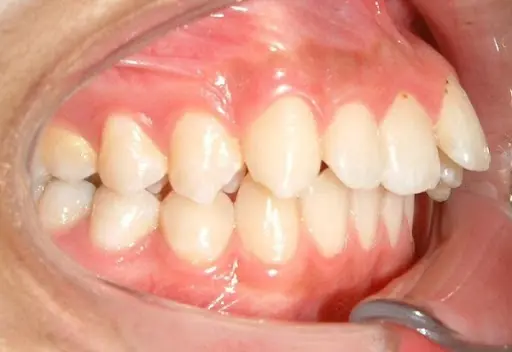 niềng răng hàm trên