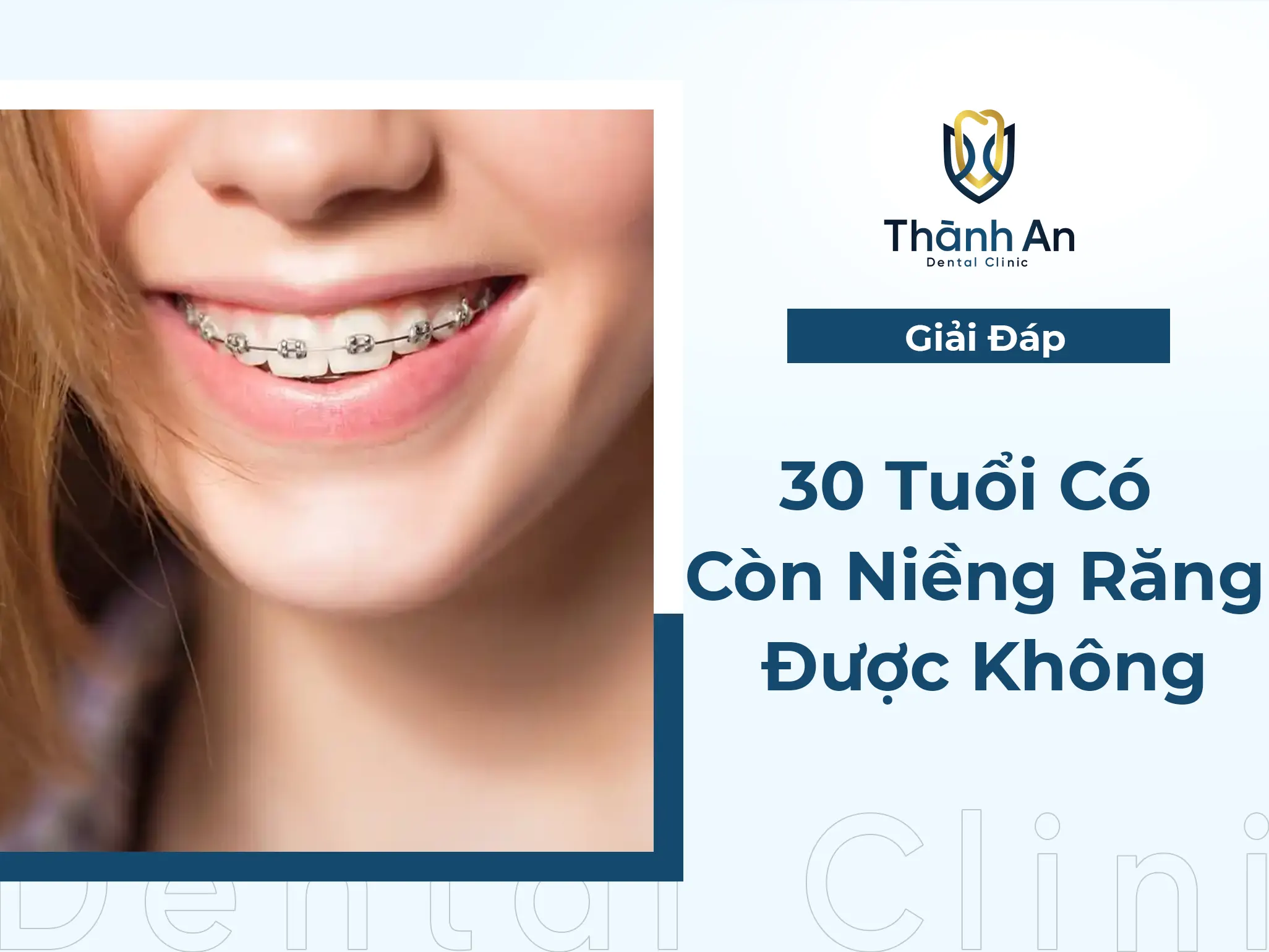 #[Giải Đáp] 30 Tuổi Có Còn Niềng Răng Được Nữa Hay Không?