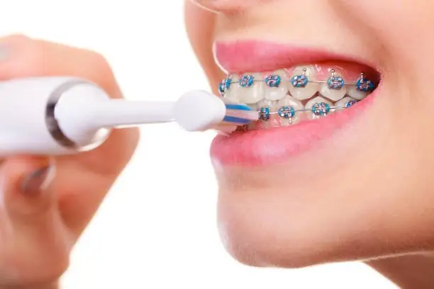 niềng răng có nên dùng bàn chải điện