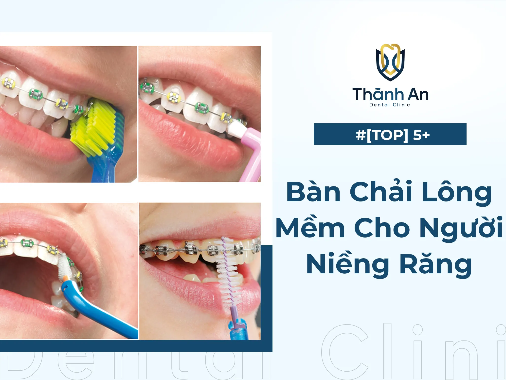 ​​​​​​​#[TOP] 5+ Bàn Chải Lông Mềm Cho Người Niềng Răng Tốt Nhất