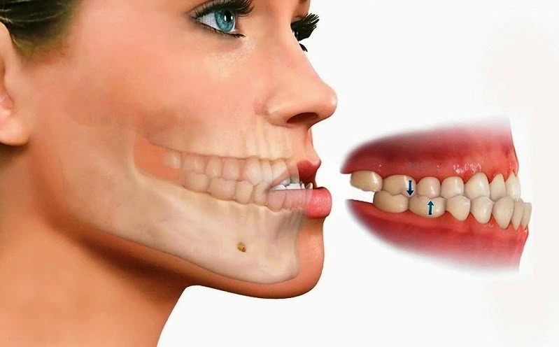 quá trình niềng răng móm