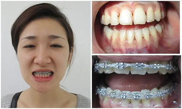 giai đoạn xấu nhất khi niềng răng