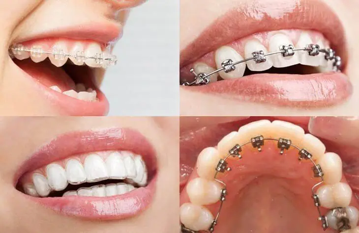 giai đoạn niềng răng