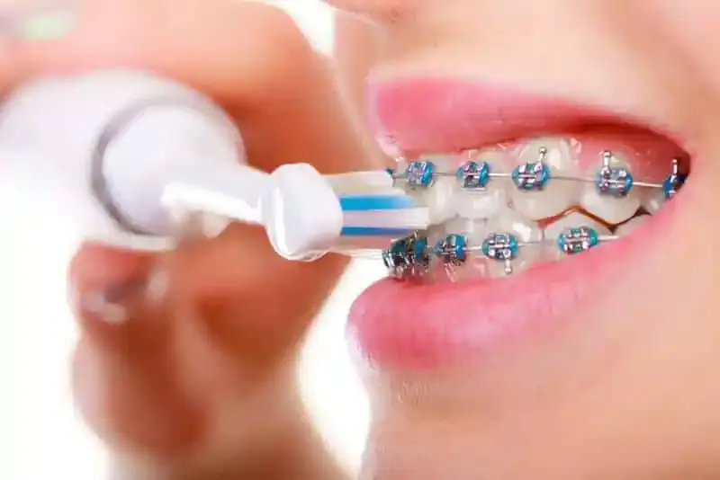 cách đánh răng cho người niềng răng