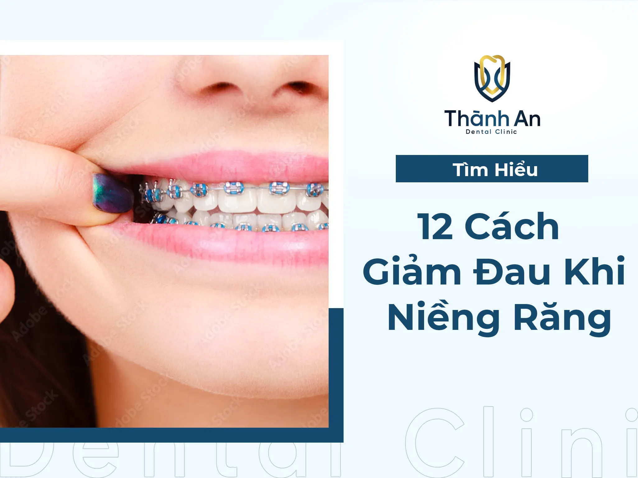 # [TOP] 12 Cách Giảm Đau Hiệu Quả Sau Khi Niềng Răng