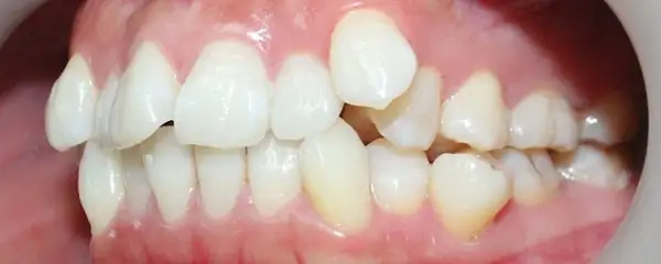 niềng răng khểnh có phải nhổ răng không