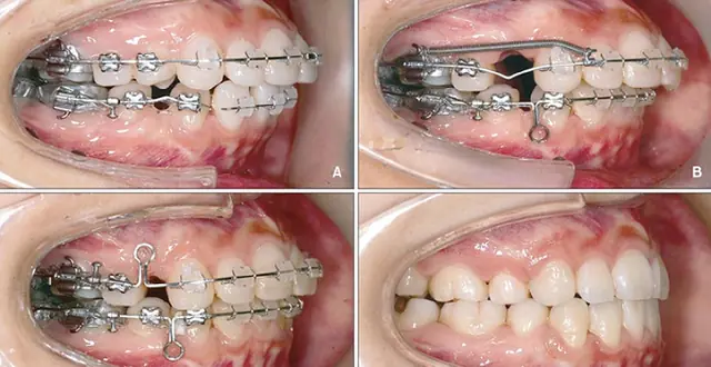 niềng răng phải nhổ răng có ảnh hưởng gì không