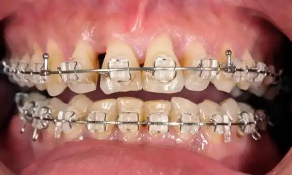 niềng răng có ảnh hưởng gì không