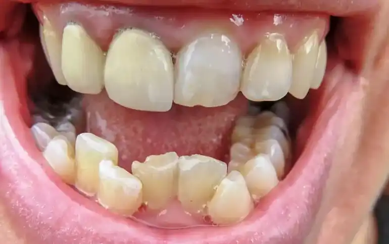 tác dụng phụ của việc niềng răng