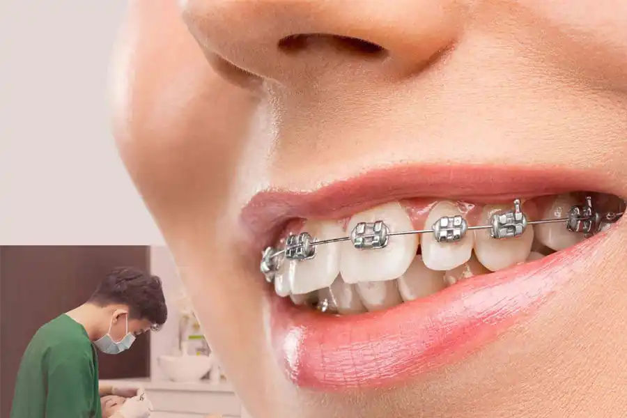 niềng răng có tác dụng gì