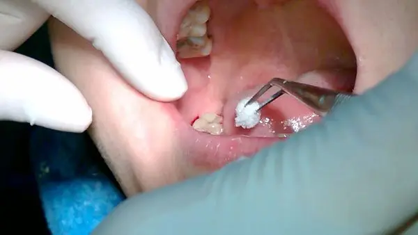 những biến chứng sau khi nhổ răng số 8