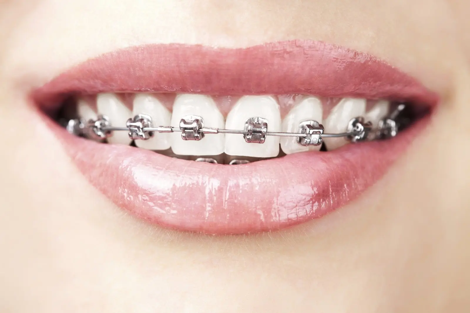 cách giữ răng trắng khi niềng răng