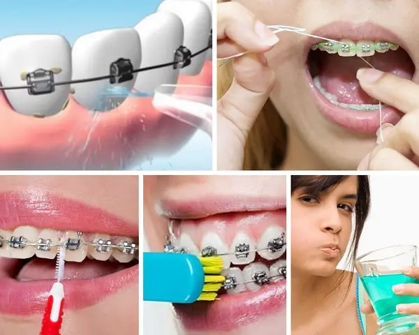 hướng dẫn vệ sinh răng miệng khi mang mắc cài