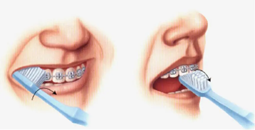 hướng dẫn vệ sinh răng miệng khi mang mắc cài