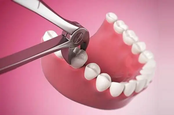 nhổ răng khôn bảo hiểm y tế