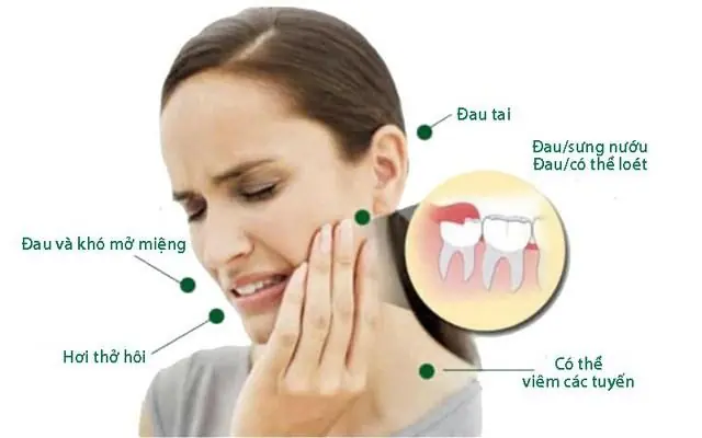Mọc răng khôn đau họng phải làm sao? Nguyên nhân và cách nhận biết