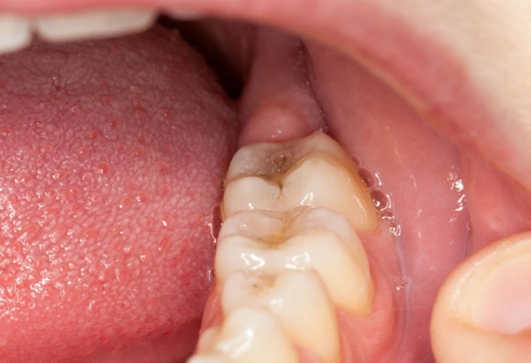 giảm đau lợi trùm răng khôn