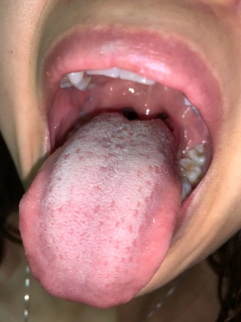 lưỡi bị tê sau khi nhổ răng khôn