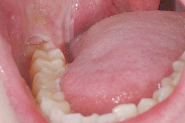lưỡi bị tê sau khi nhổ răng khôn