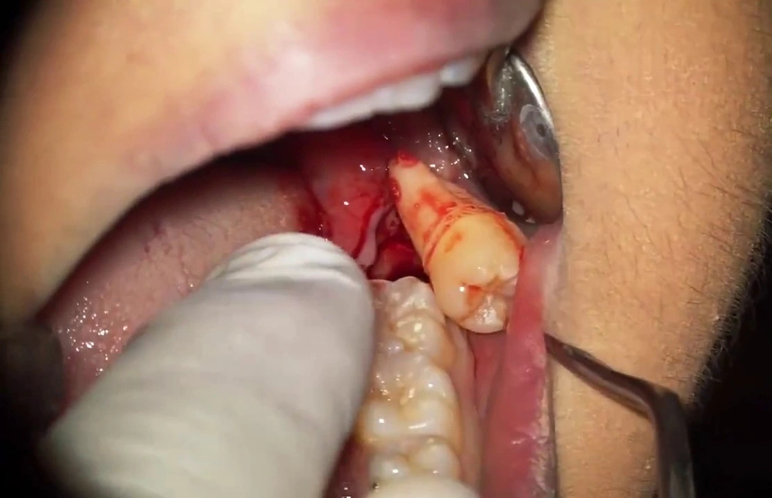 dấu hiệu nhiễm trùng sau khi nhổ răng khôn