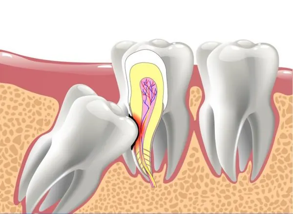 nhổ răng khôn có ảnh hưởng đến thần kinh không