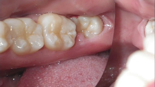 răng khôn mọc lệch hàm dưới có nên nhổ không