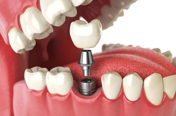 răng implant