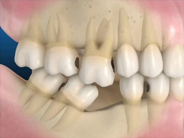 trồng răng bằng phương pháp implant