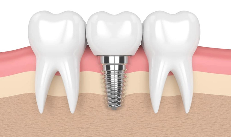 trồng implant