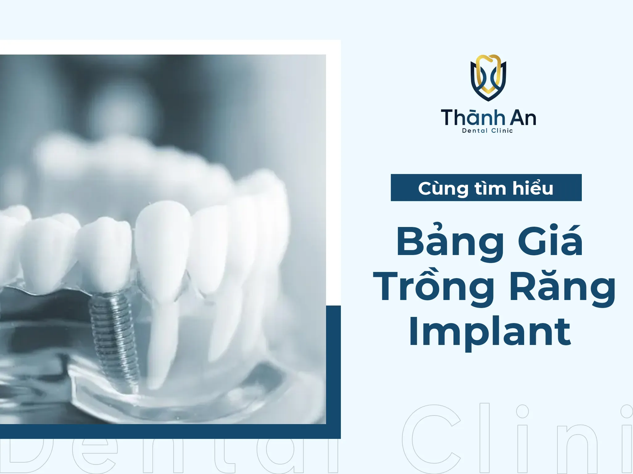 Bảng Giá Trồng Răng Implant Trọn Gói Mới Nhất – Uy Tín Nhất
