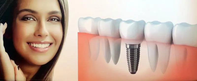 trồng răng implant giá