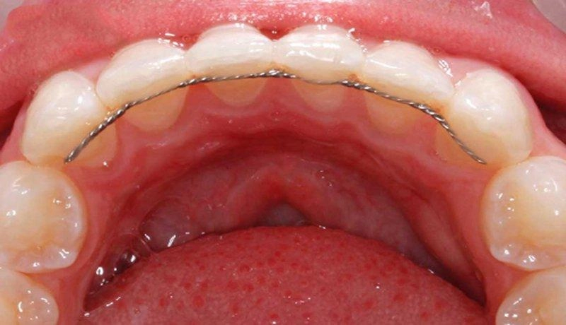 hàm duy trì sau niềng răng