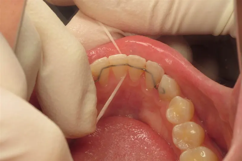 hàm cố định sau niềng răng