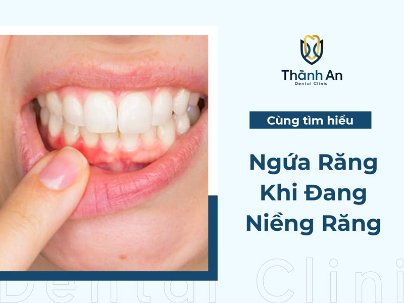 Ngứa Răng Khi Đang Niềng Răng Phải Làm Sao?