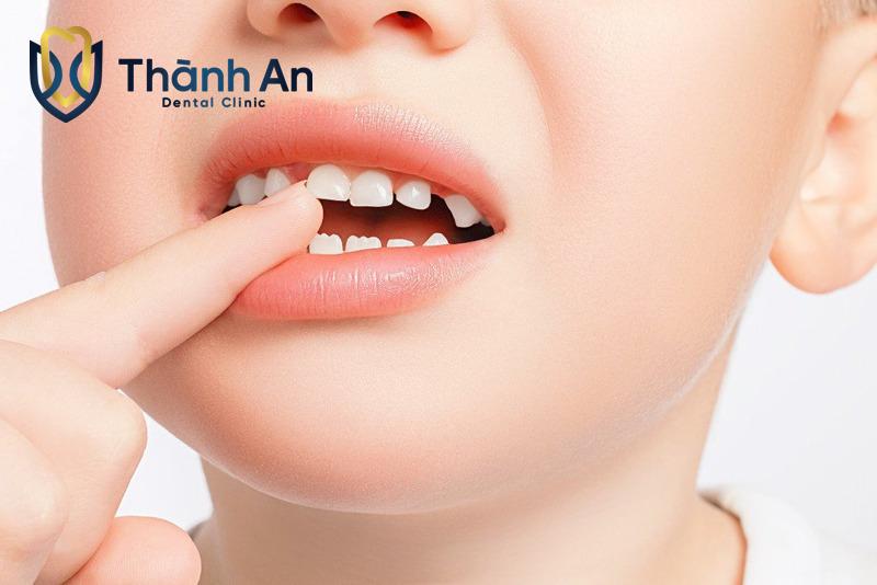 Thưa răng mọc tỉ lệ cung răng hàm không đều phức tạp