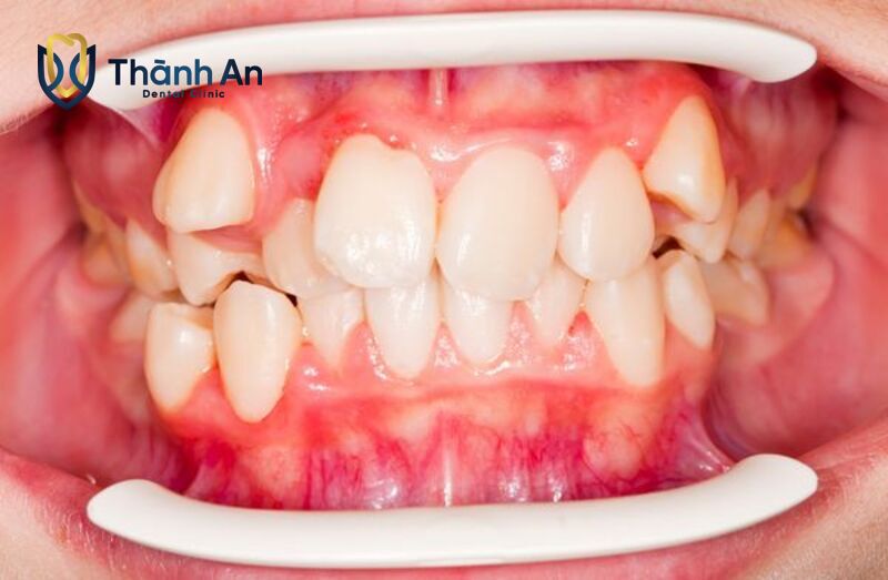 tác hại của răng mọc lệch