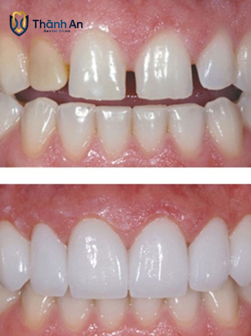 Phương pháp bọc răng sứ hoặc dán sứ